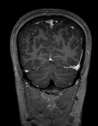 Cerebral arteriovenous malformation at posterior body of corpus callosum (Radiopaedia 74111-84925 K 307).jpg