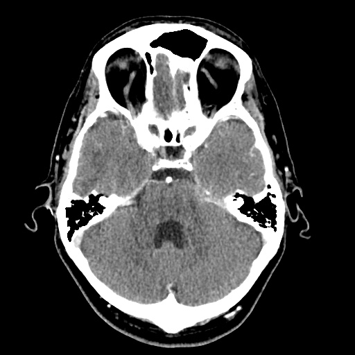 Cerebral arteriovenous malformation with lobar hemorrhage (Radiopaedia 35598-57216 A 18).jpg