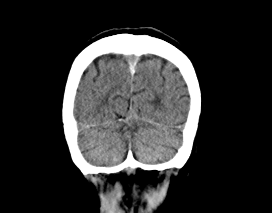 File:Cerebral arteriovenous malformation with lobar hemorrhage (Radiopaedia 44725-48510 Coronal non-contrast 41).png