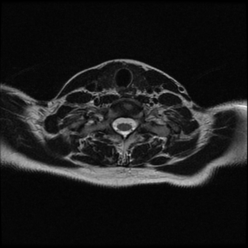 File:Cerebral autosomal dominant arteriopathy with subcortical infarcts and leukoencephalopathy (CADASIL) (Radiopaedia 41018-43763 Ax T2 C2-T1 51).png