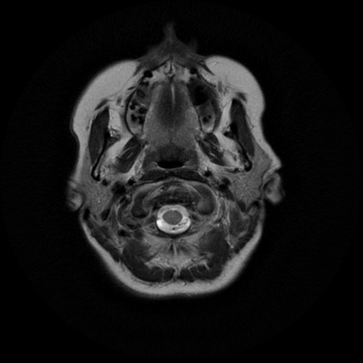 File:Cerebral autosomal dominant arteriopathy with subcortical infarcts and leukoencephalopathy (CADASIL) (Radiopaedia 41018-43763 Ax T2 PROP 1).png
