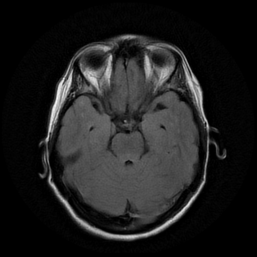 File:Cerebral autosomal dominant arteriopathy with subcortical infarcts and leukoencephalopathy (CADASIL) (Radiopaedia 41018-43768 AX FLAIR (Propeller) 7).png