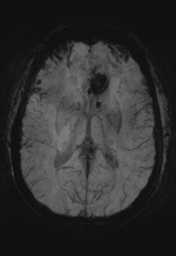 File:Cerebral cavernoma and development venous anomaly (Radiopaedia 37603-39482 Axial SWI MIP 19).png