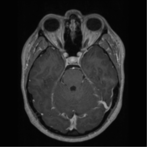 Cerebral cavernoma and development venous anomaly (Radiopaedia 37603-39482 Axial T1 C+ 26).png