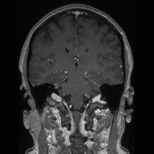 Cerebral cavernoma and development venous anomaly (Radiopaedia 37603-39482 Coronal T1 C+ 43).png