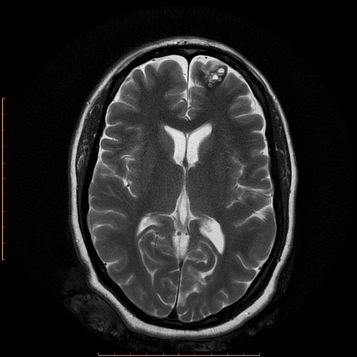 File:Cerebral cavernous malformation (Radiopaedia 26177-26306 Axial T2 12).jpg