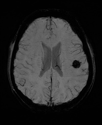 Cerebral cavernous venous malformation (Radiopaedia 70008-80021 Axial SWI 45).jpg