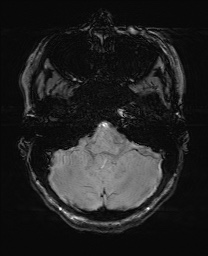 File:Cerebral cavernous venous malformation (Radiopaedia 70008-80021 I 14).jpg