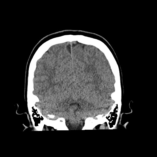 Cerebral cavernous venous malformation (Radiopaedia 70008-80022 non-contrast 52).jpg