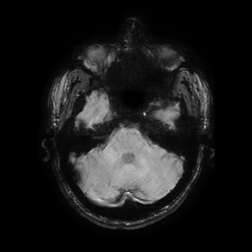 Cerebral cavernous venous malformation (Zabramski type II) (Radiopaedia 85511-101198 Axial SWI 40).jpg