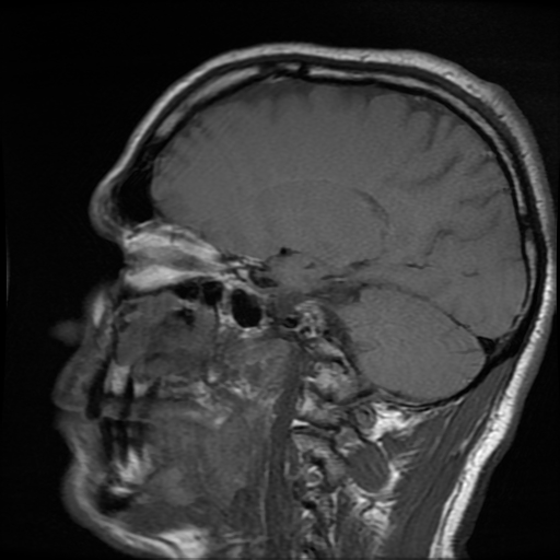 File:Cerebral cavernous venous malformation (Zabramski type II) (Radiopaedia 85511-101198 Sagittal T1 15).jpg