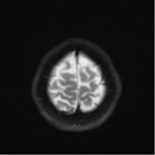 Cerebral cavernous venous malformations (Radiopaedia 48117-52946 Axial DWI 25).png