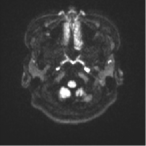 Cerebral cavernous venous malformations (Radiopaedia 48117-52946 Axial DWI 29).png