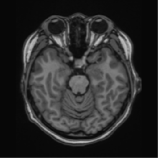 File:Cerebral cavernous venous malformations (Radiopaedia 48117-52946 Axial T1 8).png