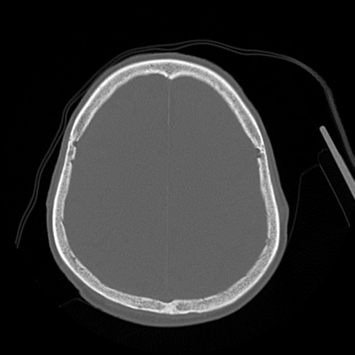 Cerebral contusions, subarachnoid hemorrhage and subdural hygromas (Radiopaedia 55399-61827 Axial bone window 38).png
