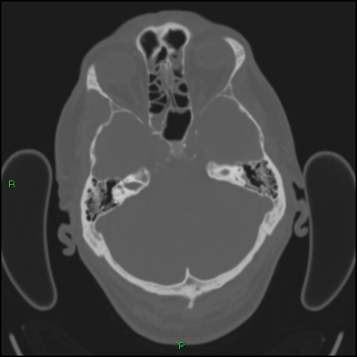 Cerebral contusions (Radiopaedia 33868-35039 Axial bone window 50).jpg