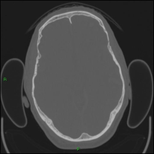 Cerebral contusions (Radiopaedia 33868-35039 Axial bone window 88).jpg