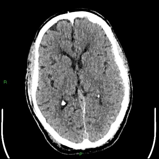 Cerebral contusions (Radiopaedia 33868-35039 Axial non-contrast 106).jpg