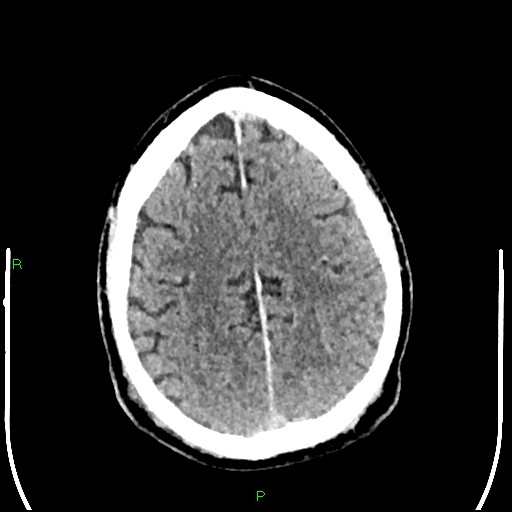 Cerebral contusions (Radiopaedia 33868-35039 Axial non-contrast 163).jpg