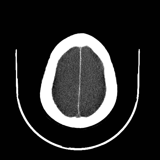 Cerebral edema (evolution in time) (Radiopaedia 19418-19439 non-contrast 78).jpg