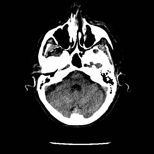 File:Cerebral edema (evolution in time) (Radiopaedia 19418-19441 non-contrast 27).jpg