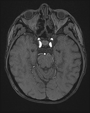 Cerebral embolic infarcts (embolic shower) (Radiopaedia 72391-82921 Axial MRA 53).jpg