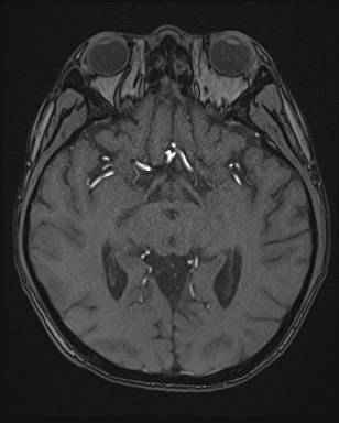 Cerebral embolic infarcts (embolic shower) (Radiopaedia 72391-82921 Axial MRA 74).jpg