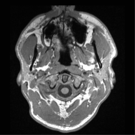 File:Cerebral hemorrhagic contusions- temporal evolution (Radiopaedia 40224-42757 Axial T1 1).png