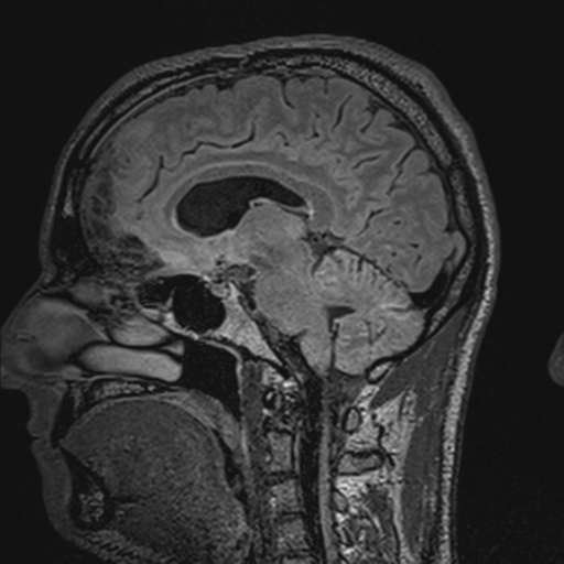File:Cerebral hemorrhagic contusions. temporal evolution (Radiopaedia 40224-42757 Sagittal 6).png