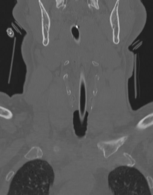 Cerebral hemorrhagic contusions and cervical spine fractures (Radiopaedia 32865-33841 Coronal bone window 4).jpg