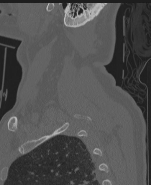 Cerebral hemorrhagic contusions and cervical spine fractures (Radiopaedia 32865-33841 Sagittal bone window 90).jpg
