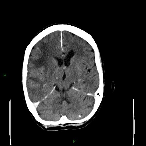 Cerebral metastases - breast primary (Radiopaedia 77653-89857 Axial C+ delayed 56).jpg