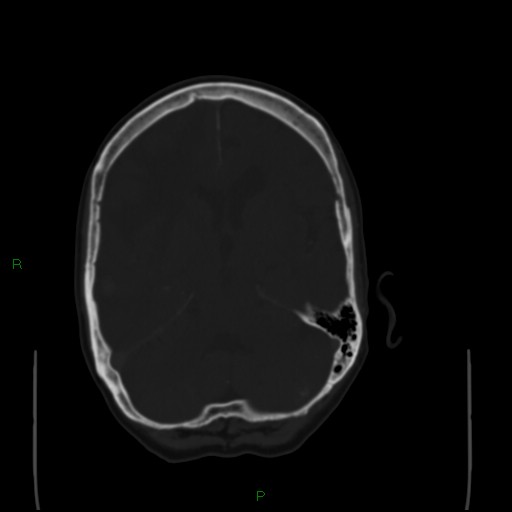 File:Cerebral metastases - breast primary (Radiopaedia 77653-89857 Axial bone window 48).jpg