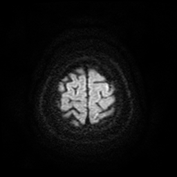 Cerebral metastases - melanoma (Radiopaedia 80972-94522 Axial DWI 59).jpg