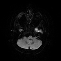 Cerebral metastases - melanoma (Radiopaedia 80972-94522 Axial DWI 8).jpg