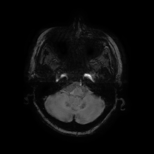 Cerebral metastases - melanoma (Radiopaedia 80972-94522 Axial SWI 21).jpg
