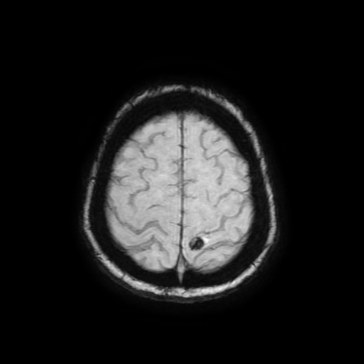 Cerebral metastases - melanoma (Radiopaedia 80972-94522 Axial SWI 84).jpg