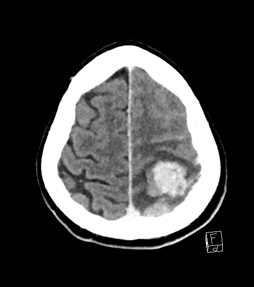 Cerebral metastases - testicular choriocarcinoma (Radiopaedia 84486-99855 Axial C+ delayed 13).jpg