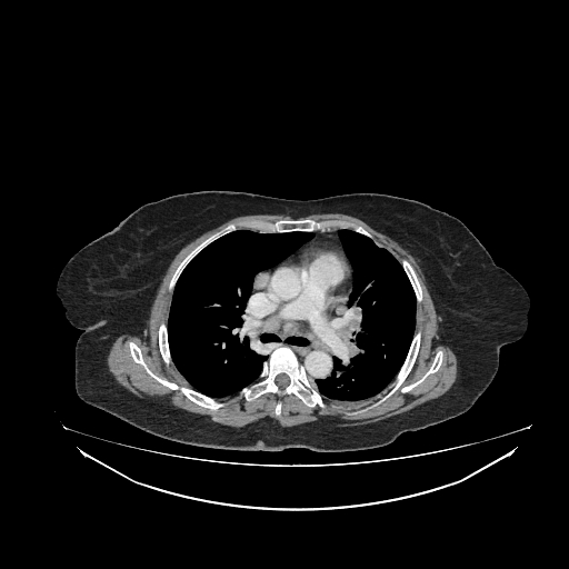 Cerebral metastases from lung cancer with amyloid angiopathy and cerebellopontine angle meningioma (Radiopaedia 74306-85223 A 25).jpg