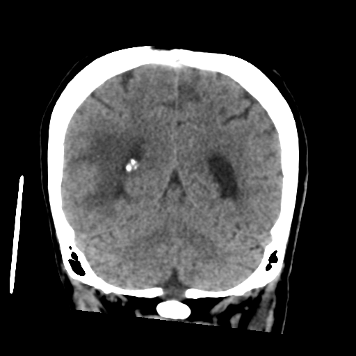 Cerebral metastasis to basal ganglia (Radiopaedia 81568-95412 Coronal non-contrast 49).png