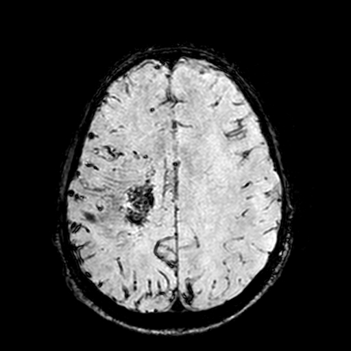 Cerebral parenchymal arteriovenous malformation (Radiopaedia 27280-27456 Axial SWI 82).jpg
