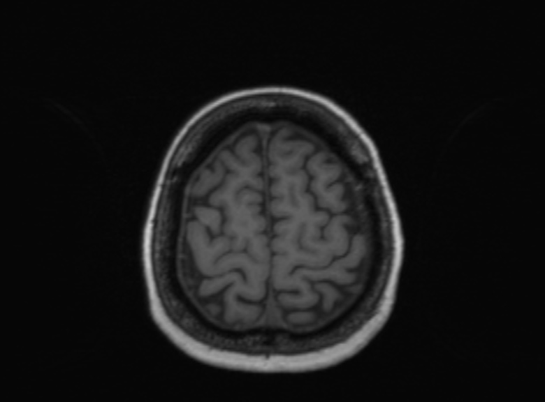 Cerebral ring enhancing lesions - cerebral metastases (Radiopaedia 44922-48817 Axial T1 130).jpg