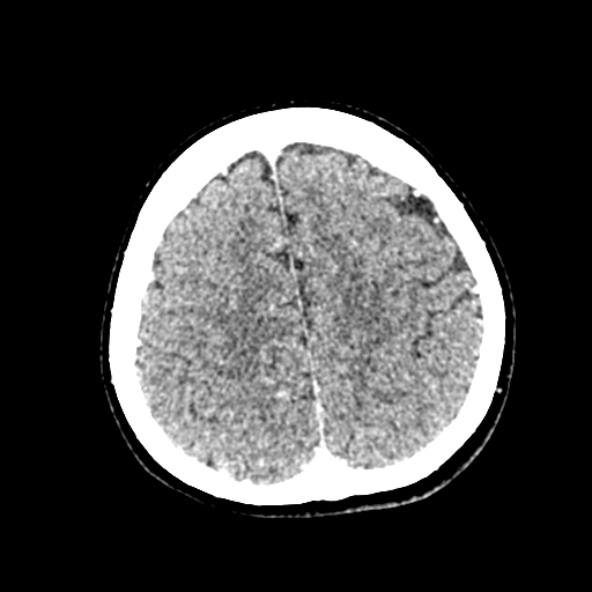 Cerebral ring enhancing lesions - cerebral metastases (Radiopaedia 44922-48818 B 220).jpg