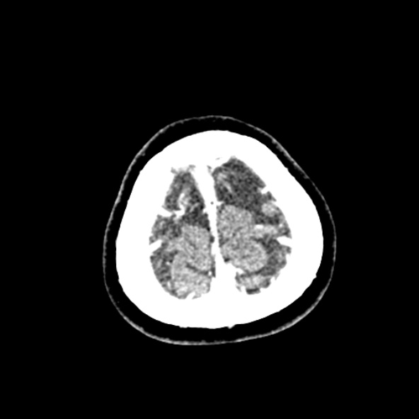 Cerebral ring enhancing lesions - cerebral metastases (Radiopaedia 44922-48818 B 266).jpg