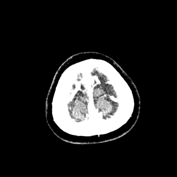 Cerebral ring enhancing lesions - cerebral metastases (Radiopaedia 44922-48818 B 271).jpg