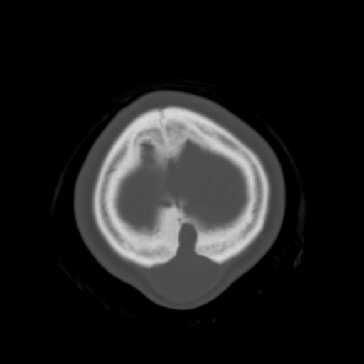 File:Cerebral tuberculosis with dural sinus invasion (Radiopaedia 60353-68018 Axial bone window 61).jpg