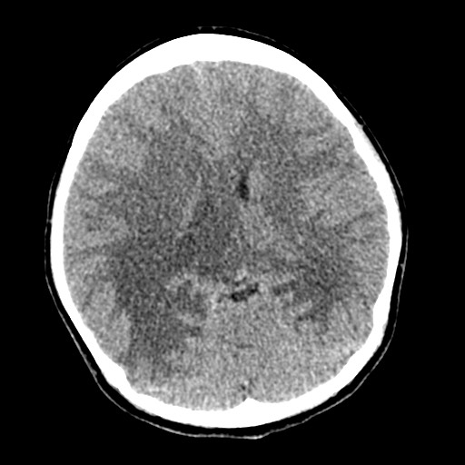 Cerebral tuberculosis with dural sinus invasion (Radiopaedia 60353-68018 Axial non-contrast 31).jpg