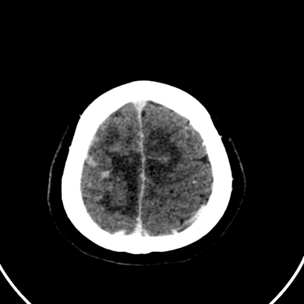 Cerebral venous hemorrhagic infarct from venous sinus thrombosis (Radiopaedia 55433-61883 Axial C+ delayed 24).jpg