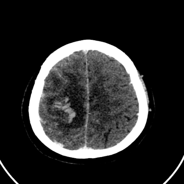 File:Cerebral venous hemorrhagic infarct from venous sinus thrombosis (Radiopaedia 55433-61883 Axial C+ delayed 34).jpg