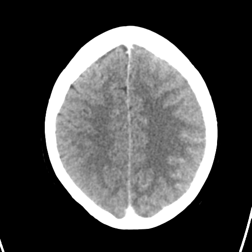 File:Cerebral venous hemorrhagic infarction (Radiopaedia 57576-64538 Axial C+ 34).png